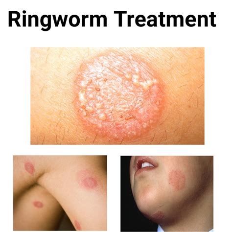 Best Medications For Ringworm Treatment - Public Health