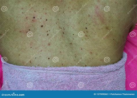 Close-up of the Skin on the Back of Women with Skin Diseases, Allergies, Rash, Redness, Itching ...