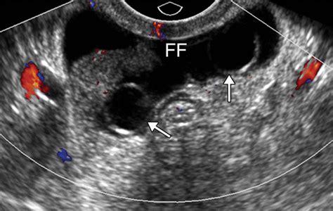 Imaging Evaluation of Fallopian Tubes and Related Disease: A Primer for ...