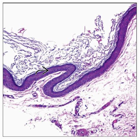 Epidermoid Cyst Histology