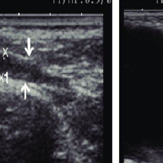 Ultrasound image of pampiniform plexus. (A) Right pampiniform plexus... | Download Scientific ...