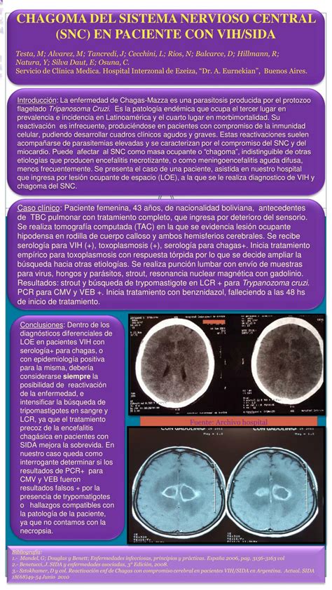 PPT - CHAGOMA DEL SISTEMA NERVIOSO CENTRAL (SNC) EN PACIENTE CON VIH/SIDA PowerPoint ...