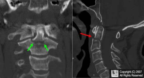 Learning Radiology - Fracture of Dens, Odontoid