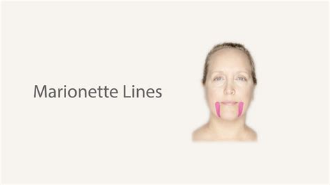 Treating Marionette Lines naturally. — Striving for Health