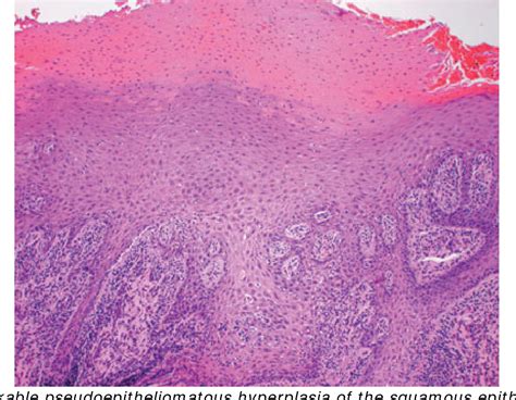 Figure 2 from Median Rhomboid Glossitis | Semantic Scholar