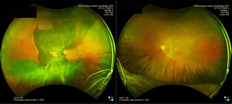 OPTOS Ultra-widefield Imaging - Northern Sydney Cataract