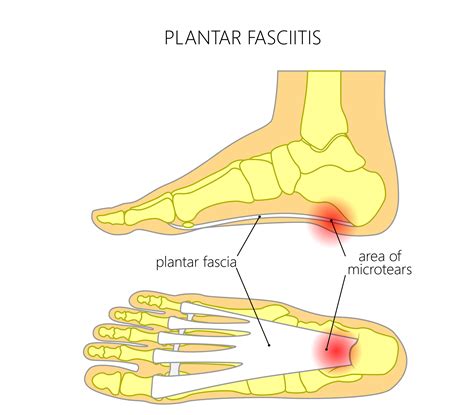 Plantar Fasciitis