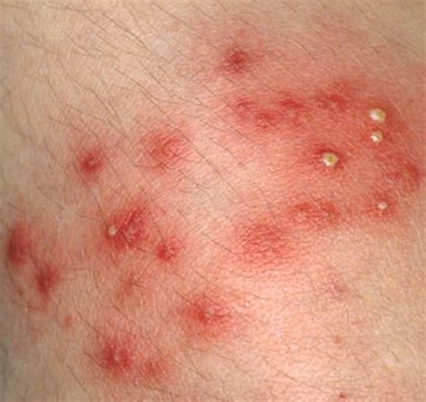 Staph Infection - Pictures, Contagious, Symptoms, Treatment, Causes | HubPages