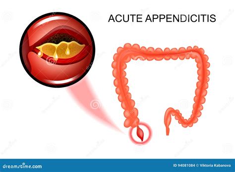 The Inflammation of the Appendix Stock Vector - Illustration of medicine, cecum: 94081084