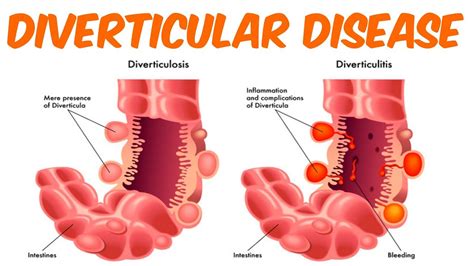 Diverticulosis And Diverticulitis