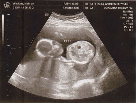 Missy's Journal: 16 Week Ultrasound Pictures