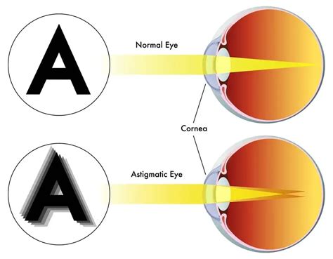 Symptoms of Astigmatism - Heffington's