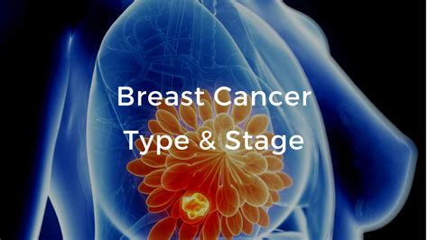 Breast Cancer Basics Video Course: Breast Cancer School for Patients