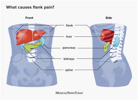 5 causes of left and right flank pain