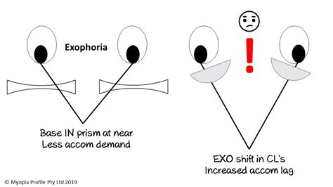 無料ダウンロード intermittent exotropia causes 341895-Causes of intermittent exotropia - Apictnyohbchh