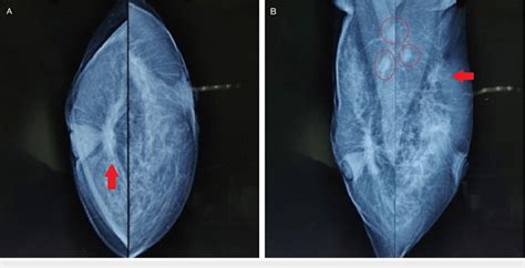 X-ray mammogram of bilateral breasts with the axilla. Arrow (panel A ...