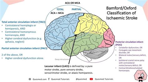 Quesmed Stroke Classification Diagram! Taken From, 47% OFF