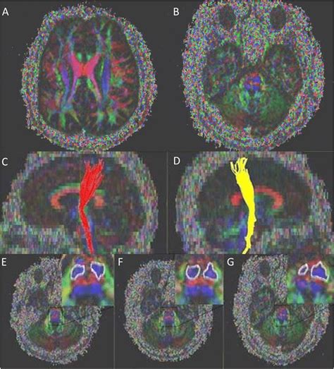 Axial color-coded fractional anisotropy map demonstrating the... | Download Scientific Diagram