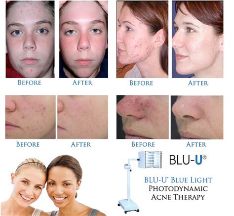 Orleans Dermatology and Laser Therapies - Photodynamic Therapy & BLU-light