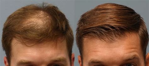 Before and After Neograft Hair Transplant - Hair Restoration Savannah