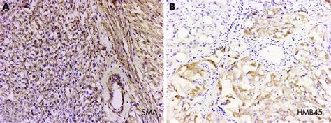 (A) Staining of smooth-muscle actin (SMA) confirms the existence of the ...