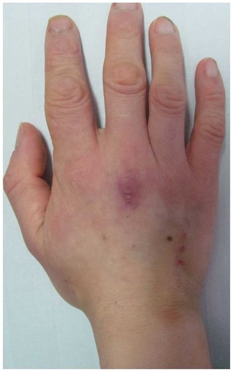 Acute basophilic leukemia presenting with maculopapular rashes and a gastric ulcer: A case report