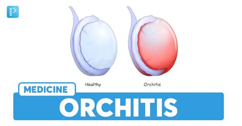 Orchitis: Causes, Symptoms, Risk Factors, Diagnosis, Treatment ...