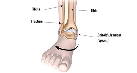 Deltoid Ligament Injury