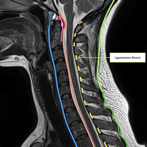 Neck Ligaments