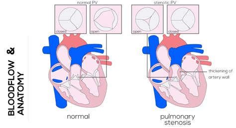 Congenital Defects Tutorial - Congenital Heart Defects | Atlas of Human Cardiac Anatomy