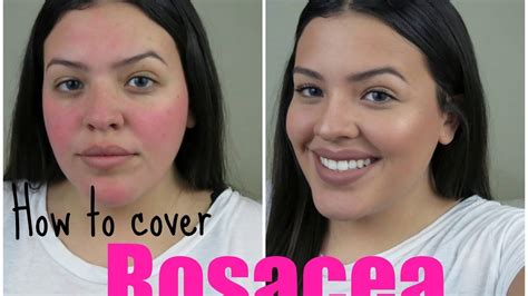 Updated Rosacea Cover-Up Makeup Tutorial | DomGBeauty | Rosacea treatment