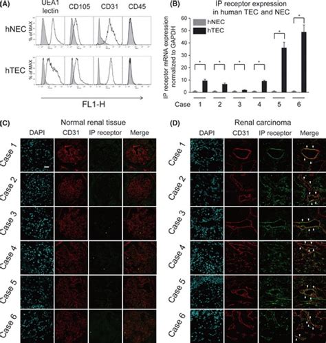 The prostacyclin receptor (IP receptor) was upregulated in human tumor ...