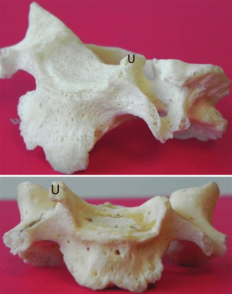 Photographs of a Type II uncinate process; lateral (upper) and anterior... | Download Scientific ...