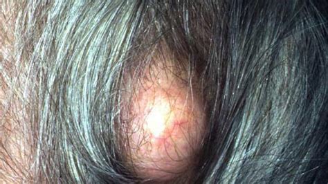 Scabs on Scalp: Everything You Need to Know - Wimpole Clinic