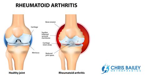 A brief guide to rheumatoid arthritis and knees - Chris Bailey Orthopaedics