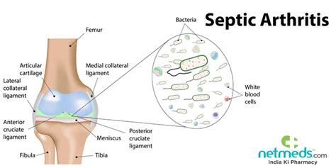 Septic Arthritis Causes, Symptoms and Treatment