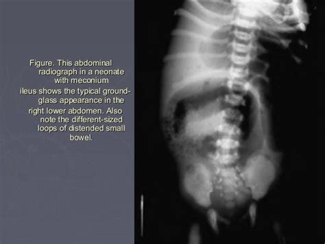 Meconium disease