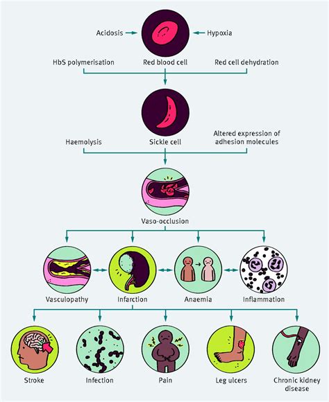 Management of sickle cell disease in the community | The BMJ