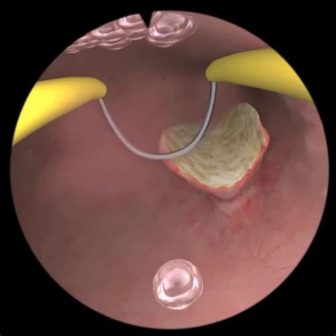 Hyst Mentor Polyp Removal | Simbionix