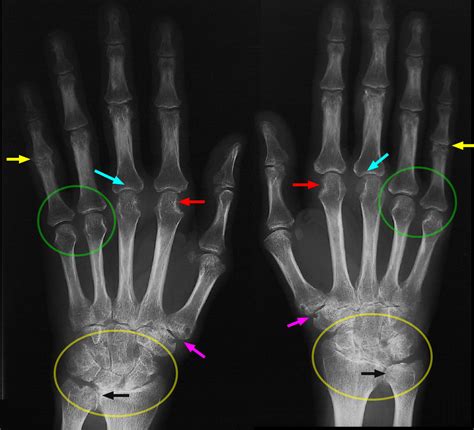 Rheumatoid Arthritis Hand X Ray