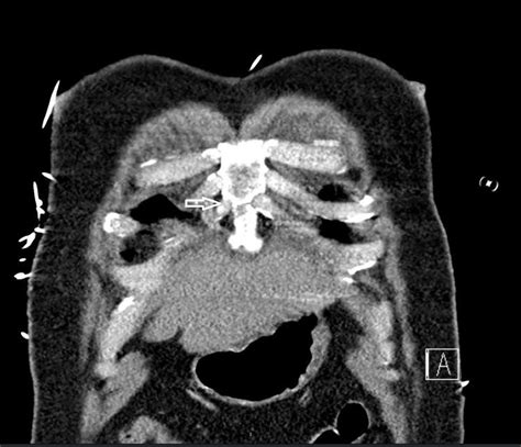 Computed tomography scan showing nondisplaced sternal body fracture ...