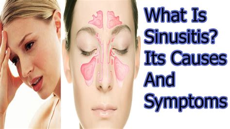 what is Sinusitis? Its Causes And Symptoms - YouTube