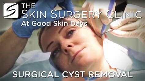 Cyst Removal | Watch the Procedure - YouTube