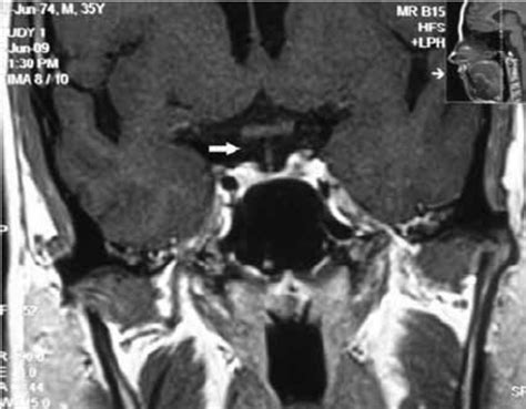 MRI pituitary coronal view showing pituitary fossa filled with ...