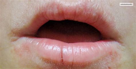 Eczema On Lips: Types, Causes, Symptoms, Treatment, And More!