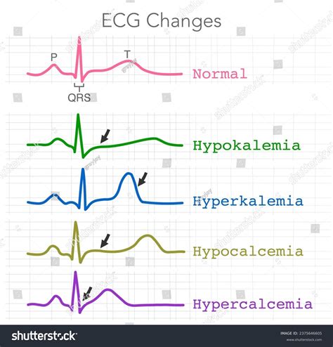 ECG changes. Hypokalemia, Hyperkalemia, - Royalty Free Stock Vector ...