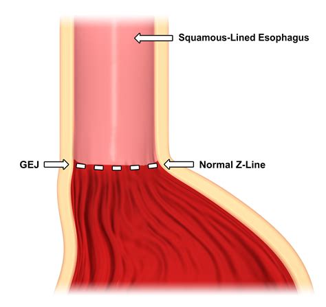 Donald Backos Artstation Portfolio - Barrett's Esophagus Diagrams