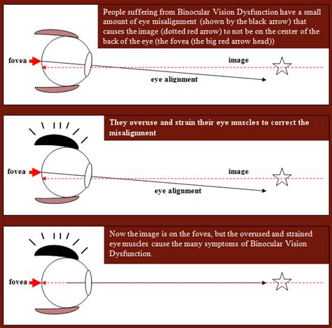 Symptoms of Binocular Vision Dysfunction - VS of M