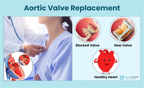 Aortic Valve Replacement: Procedure, Risks, Recovery Time