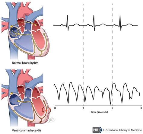 Catecholaminergic polymorphic ventricular tachycardia: MedlinePlus Genetics